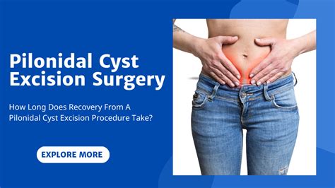 When an abscess forms, it needs to be drained. . Is pilonidal cyst surgery worth it